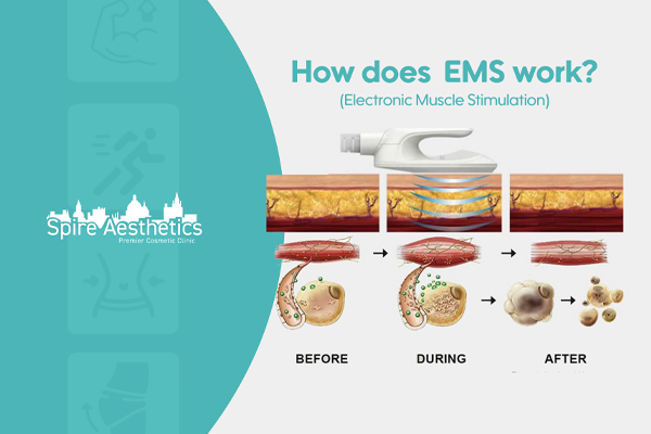 EMS treatment for post pregnancy weight loss treatment Tonbridge