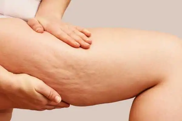 Image of woman showing leg with cellulite Tonbridge