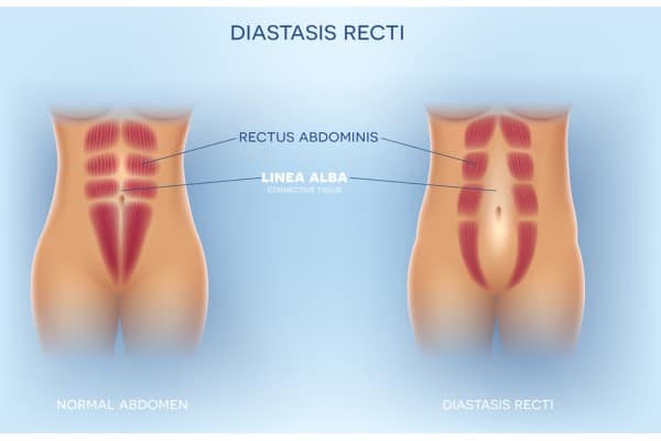 What Non-Surgical Options Are Available for Diastasis Recti Tonbridge?