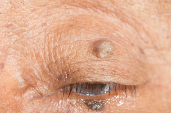 Skin imperfections Tonbridge - Cryopen is fast and effective book in today!