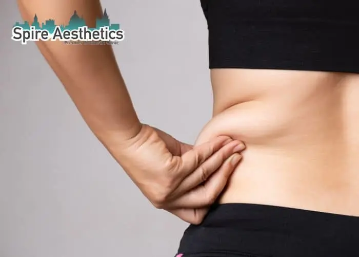 Image of woman pinching fat on their hips Tonbridge. Fat Freezing treatment