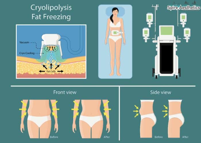 Image of diet and fat freezing combined for best results for Spire Aesthetics Tonbridge
