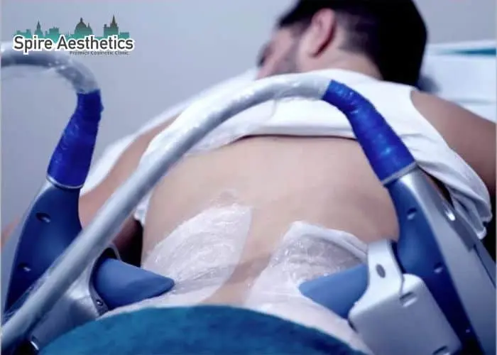 Man having fat freezing treatment done on love handles before a competitions Tonbridge to create a sculpted look.