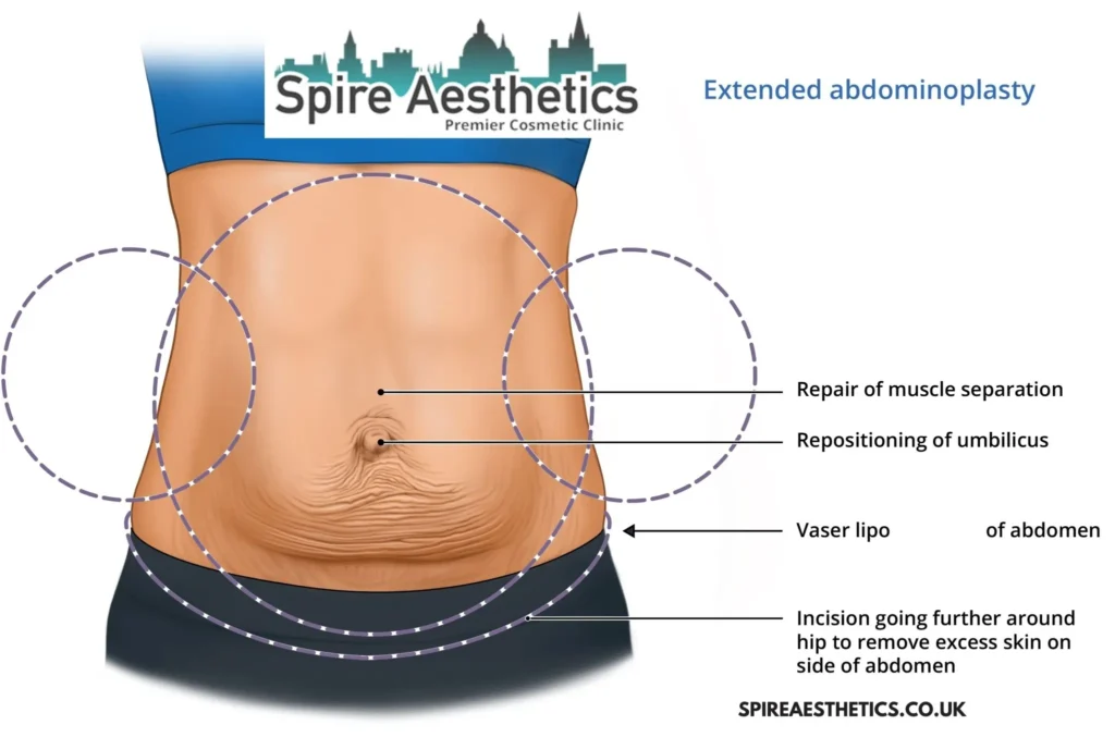 Understanding Loose Skin After Gastric Band Tonbridge Surgery and HIFU Treatment