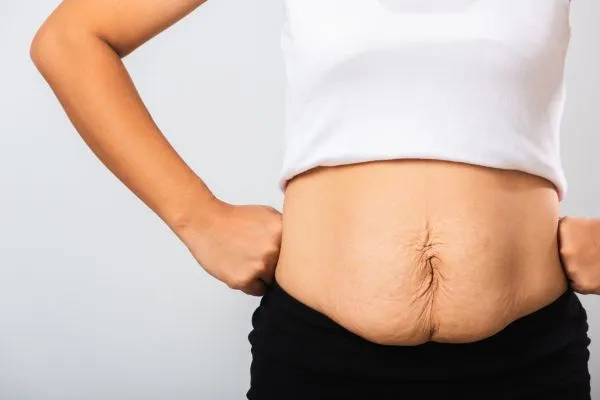 Image of a woman's stomach after weight loss with sagging skin following a gastric band Tonbridge