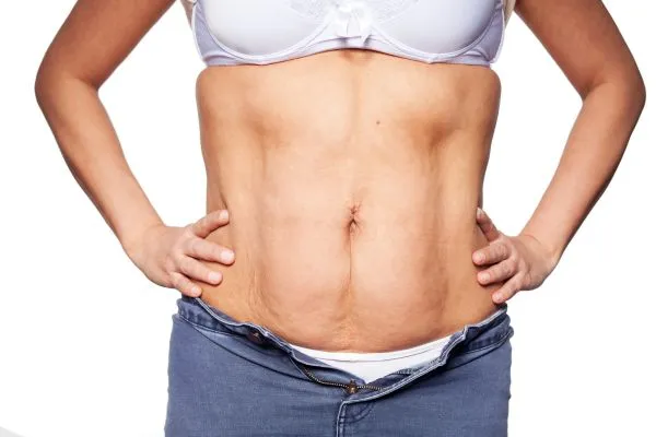 sagging skin on woman's stomach after weight loss injections Tonbridge
