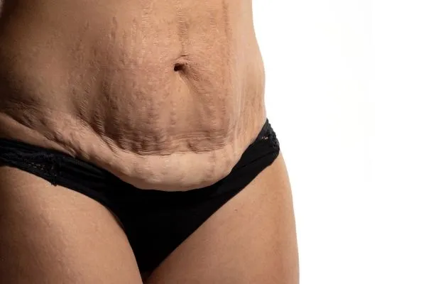 Image of womans stomach after weight loss injections Tonbridge showing saggy skin