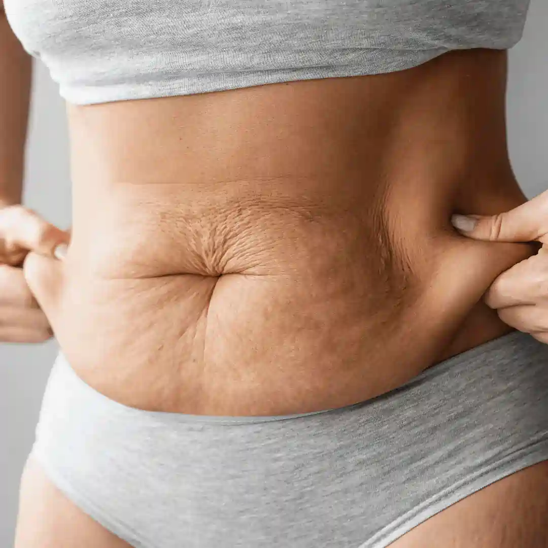 Is It Normal to Have Loose Skin After Pregnancy Tonbridge?