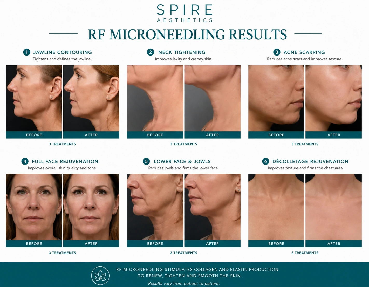 RF Microneedling Skin tightening Tonbridge results