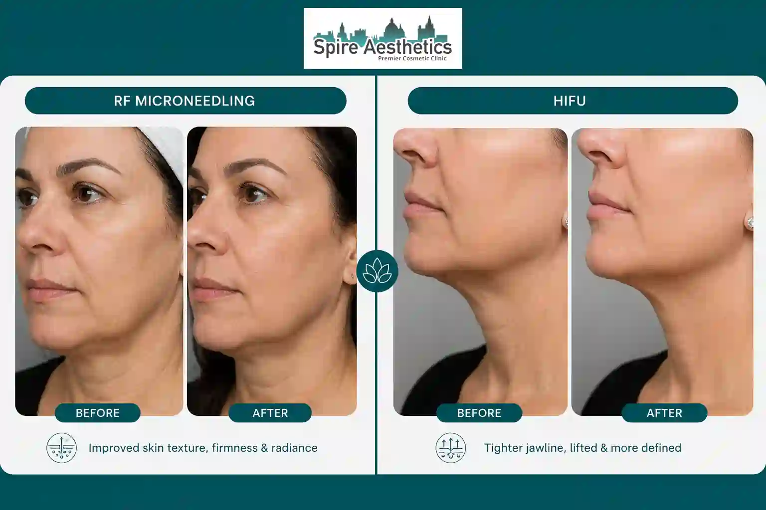 Can RF Microneedling and HIFU Be Combined Tonbridge?