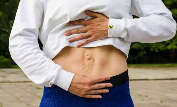 When Could Diastasis Recti Be the Missing Piece of the Puzzle Tonbridge?