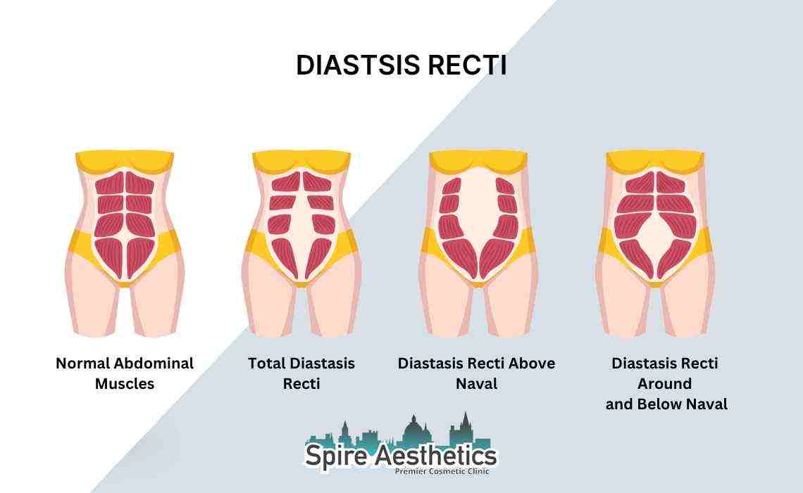 Is Non-Surgical Diastasis Recti Treatment Right for You? Common Concerns Answered Tonbridge